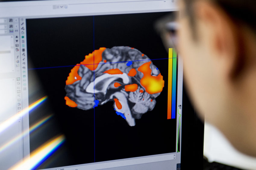 一个脑部扫描的图像出现在电脑上