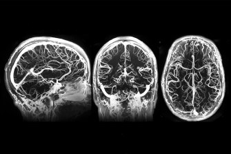 三次MRI扫描人脑
