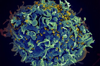 电子显微镜显示人类T细胞 蓝色受HIV攻击 黄色病毒引起AIDS